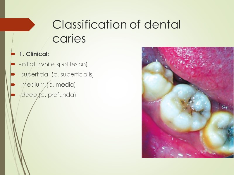 Classification of dental caries 1. Clinical: -initial (white spot lesion)  -superficial (c. superficialis)